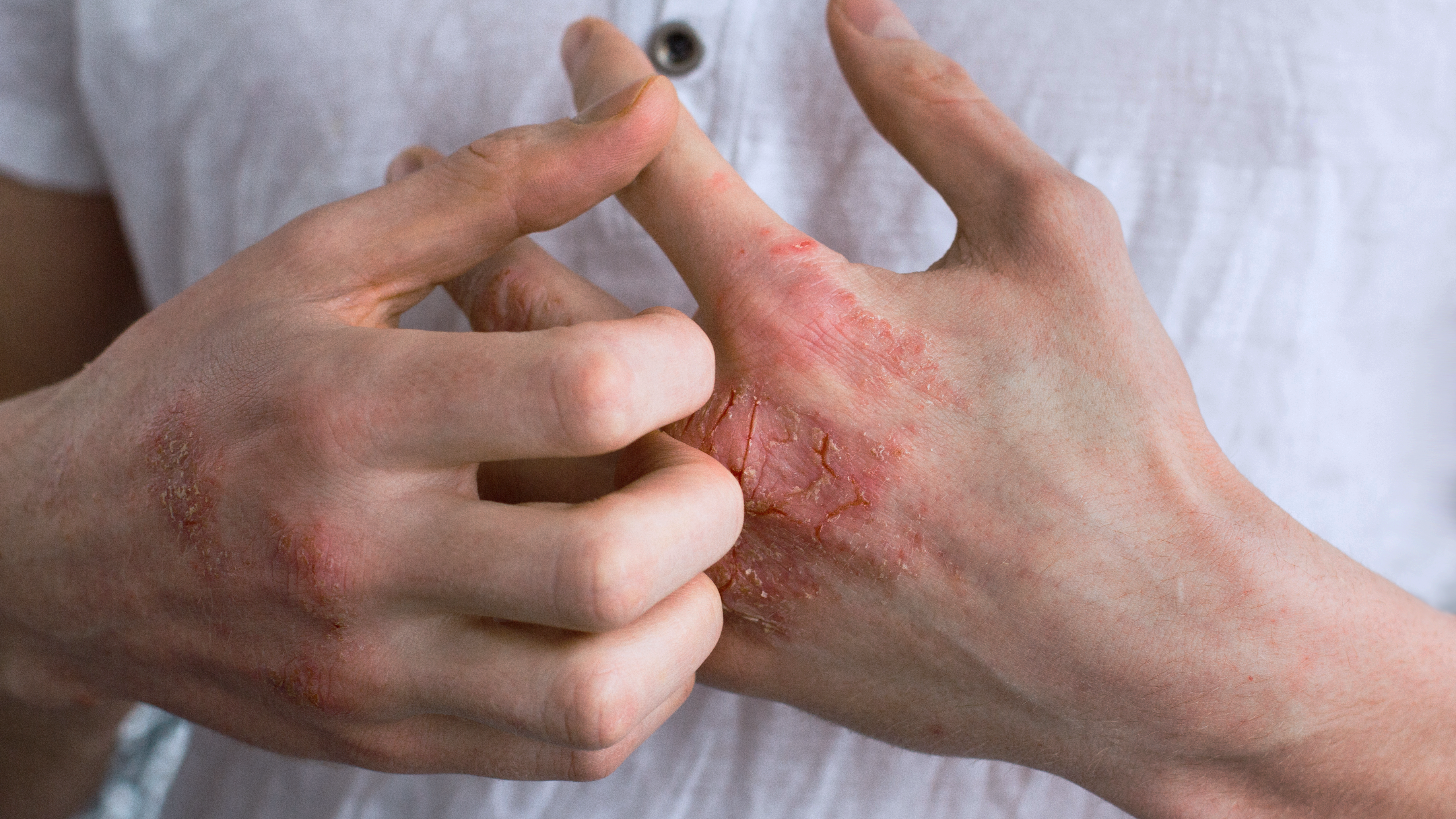 Hautpflege-mittelschwere Schübe-Ekzeme-Hände